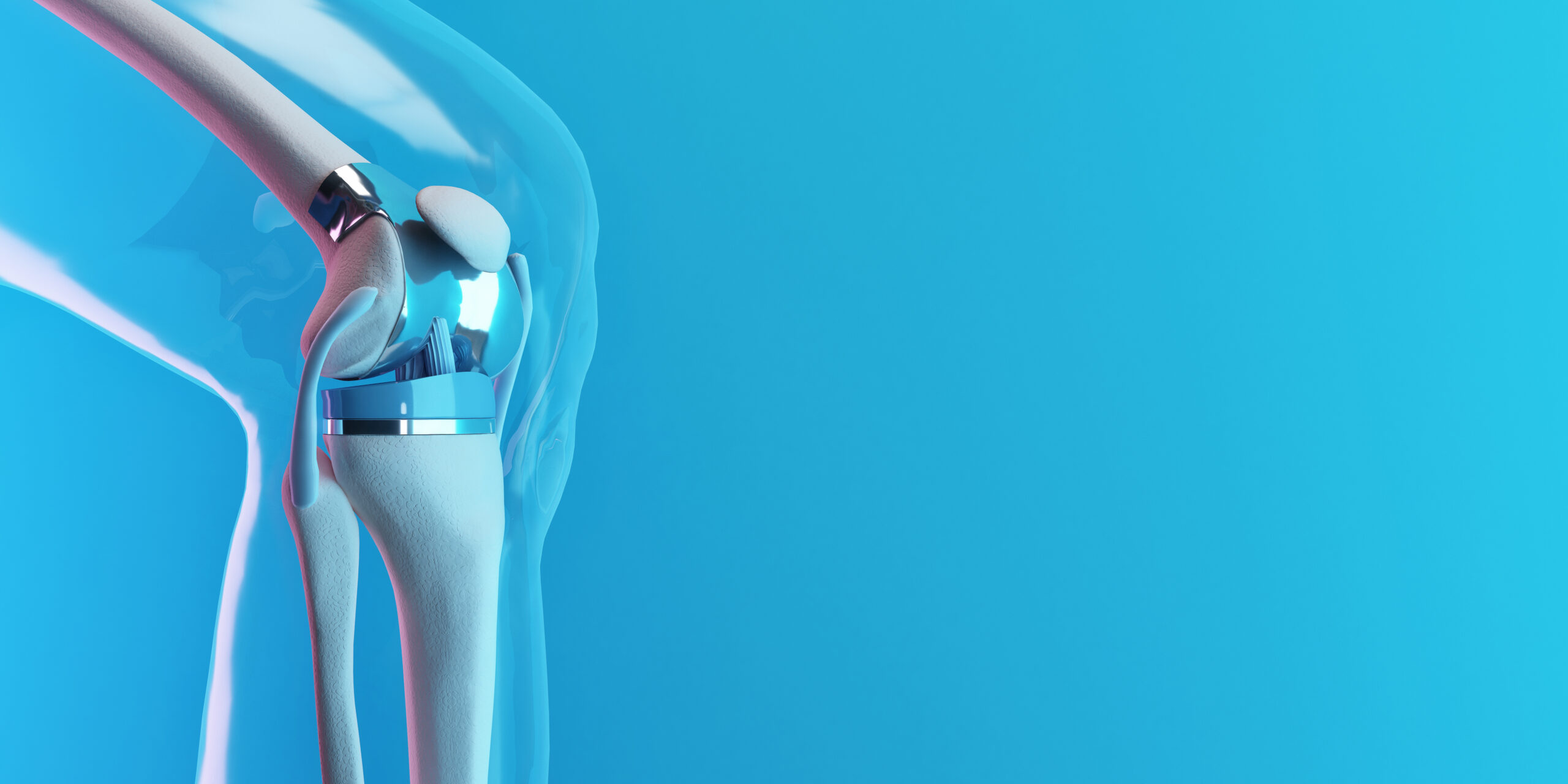 Total Knee Arthroplasty