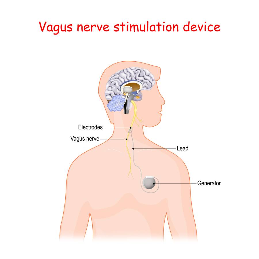 Vagus Nerve Stimulators: Anesthesia Considerations